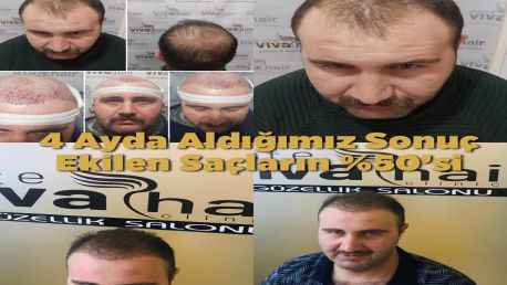 Esteviva Güzellik Merkezi -  Esteviva Hair Clinic  - Van'da Saç Ekimi